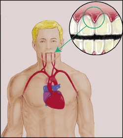 Gum Disease and Heart Disease